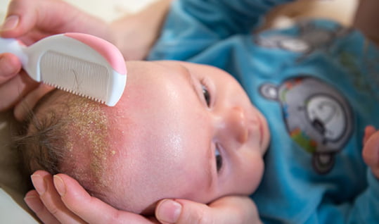 bebek saç derisi bakım rutini