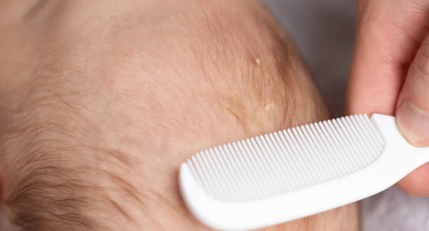 bebeklerde seboreik dermatit nedir